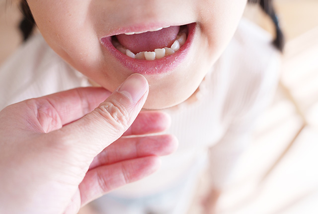 子どもの矯正（小児矯正）