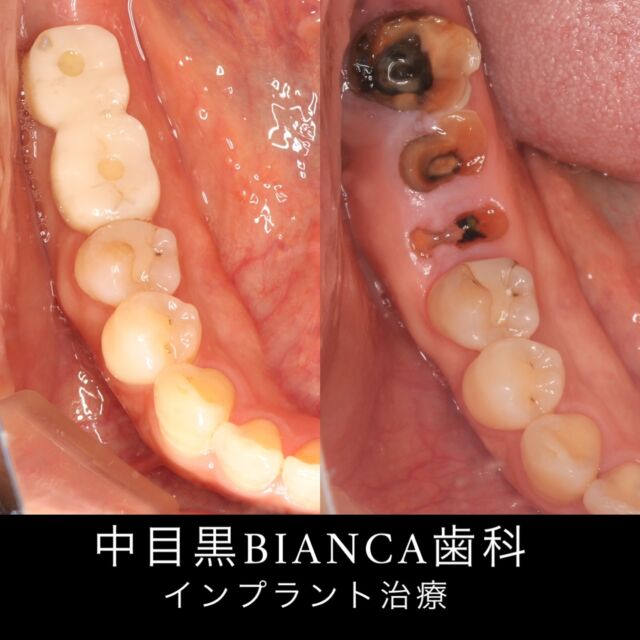 感染ががあって残せない歯は抜いて
あなたに必要な処置を！！

インプラントオペ　implantope

女性
主訴：虫歯を治したい
治療期間:3ヶ月

中目黒BIANCA歯科矯正歯科

目黒区上目黒2-1-2中目黒GTハイツ2F B-2-2
🚃中目黒駅より徒歩1分
⏰月曜:13:00〜19:00
  水木:7:30〜19:00
  土曜:9:30〜18:00
  日曜:9:30〜14:00
☎️03-6451-2175

ご予約に関して
公式LINEのメッセージ、お電話より承っております。

#implant#インプラント#歯医者#歯科医師#dentist #dental#女医#虫歯#セラミックス#ceramics